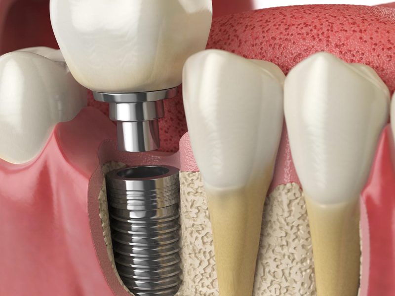Implantate_Prophylaxe_Parodontologie_Chirugie1