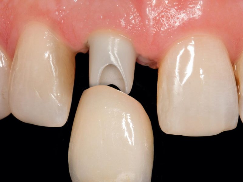 Implantate_Prophylaxe_Parodontologie_Chirugie15