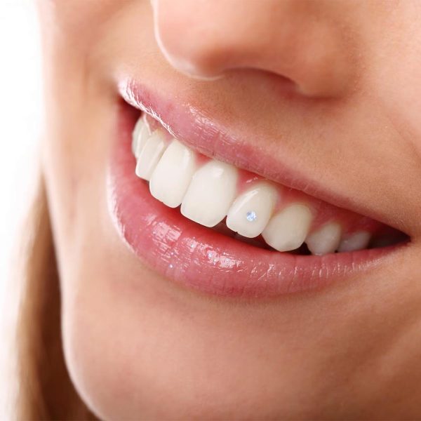 dental-jewellery