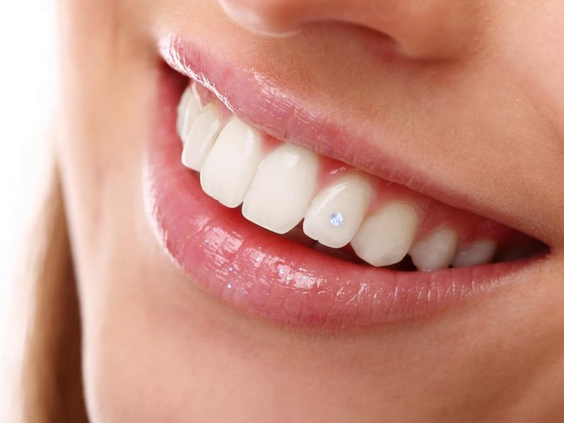 dental-jewellery